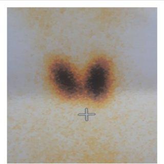Thyroid scan — diffusely enlarged gland with homogeneously increased uptake, no discrete nodules